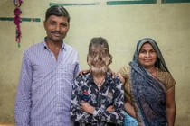 Cậu bé Ấn Độ mang khuôn mặt "người sói"