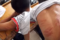 79 vết thương trên người, nam sinh lớp 8 hoảng hốt kể lại chuyện bị bố đẻ bạo hành