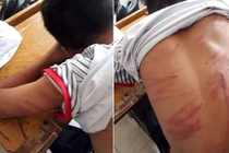79 vết thương trên người, nam sinh lớp 8 hoảng hốt kể lại chuyện bị bố đẻ bạo hành