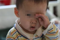 Bé trai 2 tuổi suýt bị mù vĩnh viễn chỉ vì bố mẹ 'lười'