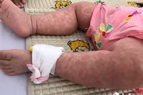 Số ca sởi dương tính tăng 22 lần, Bộ Y tế khẩn cấp tiêm vét cho trẻ