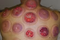 Vợ bị bỏng vì nửa đêm về sáng được chồng giác hơi