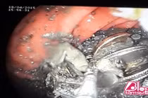 Đau bụng quằn quại, chết lặng thấy thứ ghê rợn này trong dạ dày