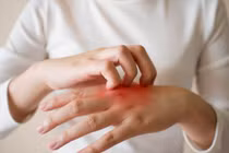 Ba triệu chứng trên da cảnh báo gan nhiễm mỡ