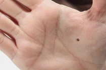 5 nốt ruồi lòng bàn tay, 1/5 cả đời an nhàn không lo tiền bạc