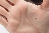 5 nốt ruồi lòng bàn tay, 1/5 cả đời an nhàn không lo tiền bạc