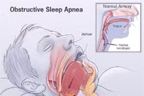 Biến chứng nguy hiểm của hội chứng ngưng thở khi ngủ