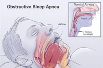 Biến chứng nguy hiểm của hội chứng ngưng thở khi ngủ