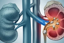 Sỏi thận khổng lồ dài 20cm sau 50 năm tồn tại trong cơ thể