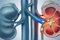 Sỏi thận khổng lồ dài 20cm sau 50 năm tồn tại trong cơ thể