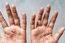 6 khuyến cáo phòng chống bệnh đậu mùa khỉ