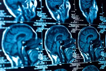 Cảnh báo bệnh thần kinh lạ gây hại giới trẻ Canada