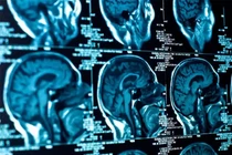 Cảnh báo bệnh thần kinh lạ gây hại giới trẻ Canada