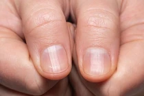 Dấu hiệu “lạ” ở bàn tay cảnh báo bệnh hiểm