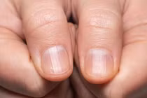 Dấu hiệu “lạ” ở bàn tay cảnh báo bệnh hiểm