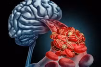 Cảnh báo 6 triệu chứng sớm của nhồi máu não