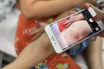 Bệnh tay chân miệng ở TP.HCM tăng báo động