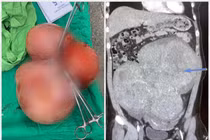 Nữ bệnh nhân 35 tuổi có khối u xơ tử cung nặng 5,5kg