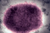 Bùng phát virus hiếm gặp và bất thường tại Anh