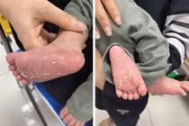 Trẻ 46 ngày tuổi bị giang mai