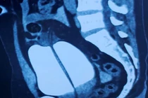 Hi hữu: Nam thanh niên nhập viện vì... vỡ bàng quang sau cuộc nhậu