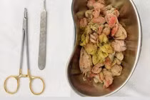 Trẻ nguy kịch vì ăn ruột gấu bông: Bác sĩ khuyến cáo gì?