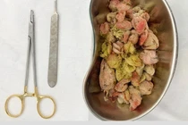 Trẻ nguy kịch vì ăn ruột gấu bông: Bác sĩ khuyến cáo gì?