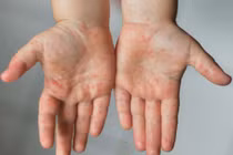 Trẻ em mắc đậu mùa khỉ có nguy hiểm?