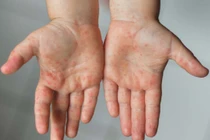 Trẻ em mắc đậu mùa khỉ có nguy hiểm?