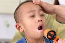 Dấu hiệu trẻ mắc tay chân miệng cần nhập viện