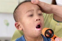Dấu hiệu trẻ mắc tay chân miệng cần nhập viện