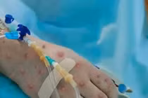 Khuyến cáo của Bộ Y tế phòng chống bệnh đậu mùa khỉ tại cửa khẩu