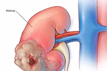 Triệu chứng ung thư thận nhiều người bỏ qua