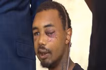 Chàng trai bị cảnh sát bắn mù mắt giữa biểu tình ở Mỹ