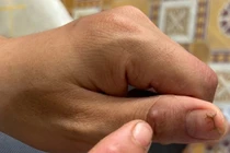 Mất nửa năm chữa vết u gai tôm đâm mới biết mình mắc bệnh lao