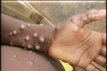 Bệnh đậu mùa khỉ lây lan qua những đường nào?