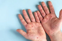 Những điều nên làm khi nghi nhiễm đậu mùa khỉ