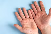 Những điều nên làm khi nghi nhiễm đậu mùa khỉ