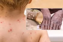 Nghi nhiễm đậu mùa khỉ, nên làm gì?