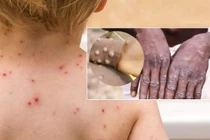 Nghi nhiễm đậu mùa khỉ, nên làm gì?