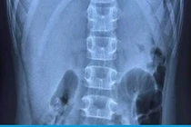 Vì sao 3 bệnh nhi ở Hải Phòng bị thủng dạ dày khi mắc COVID-19?