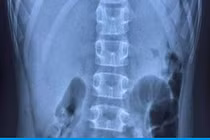 Vì sao 3 bệnh nhi ở Hải Phòng bị thủng dạ dày khi mắc COVID-19?