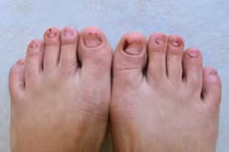 Triệu chứng ở chân cảnh báo cholesterol ở mức cao nguy hiểm