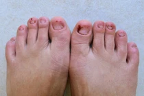 Triệu chứng ở chân cảnh báo cholesterol ở mức cao nguy hiểm