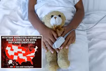 Bệnh viêm gan bí ẩn bùng phát ở Mỹ, 5 trẻ tử vong