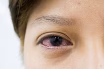 Con có triệu chứng mắt đỏ tưởng bình thường, ai ngờ mắc bệnh hiểm