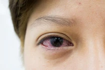 Con có triệu chứng mắt đỏ tưởng bình thường, ai ngờ mắc bệnh hiểm