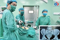 Thủng tử cung, đại tràng…vì vòng tránh thai