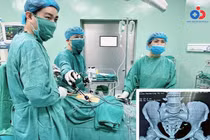 Thủng tử cung, đại tràng…vì vòng tránh thai