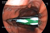 Bàn chải đánh răng, ruột bút bi trong dạ dày thanh niên 23 tuổi